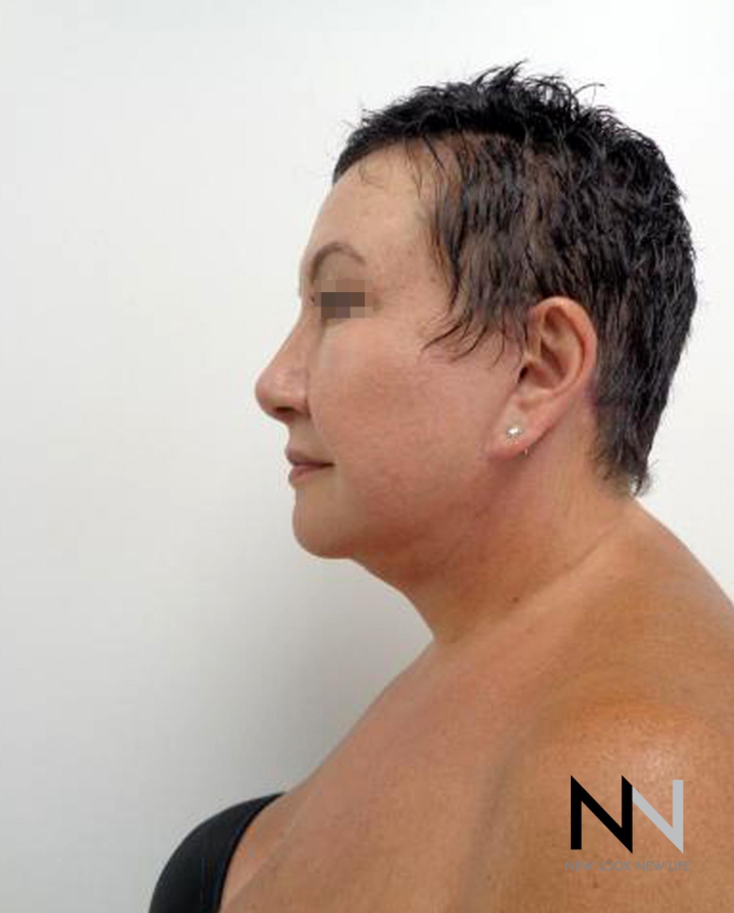 Facelift/Mini Facelift: Patient 6 - After  