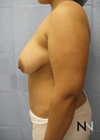 Breast Lift: Patient 6 - Before and After Image 5