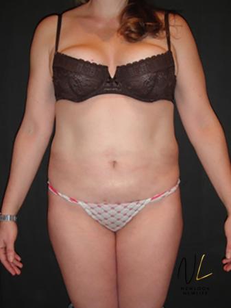 Liposuction: Patient 6 - After Image 1