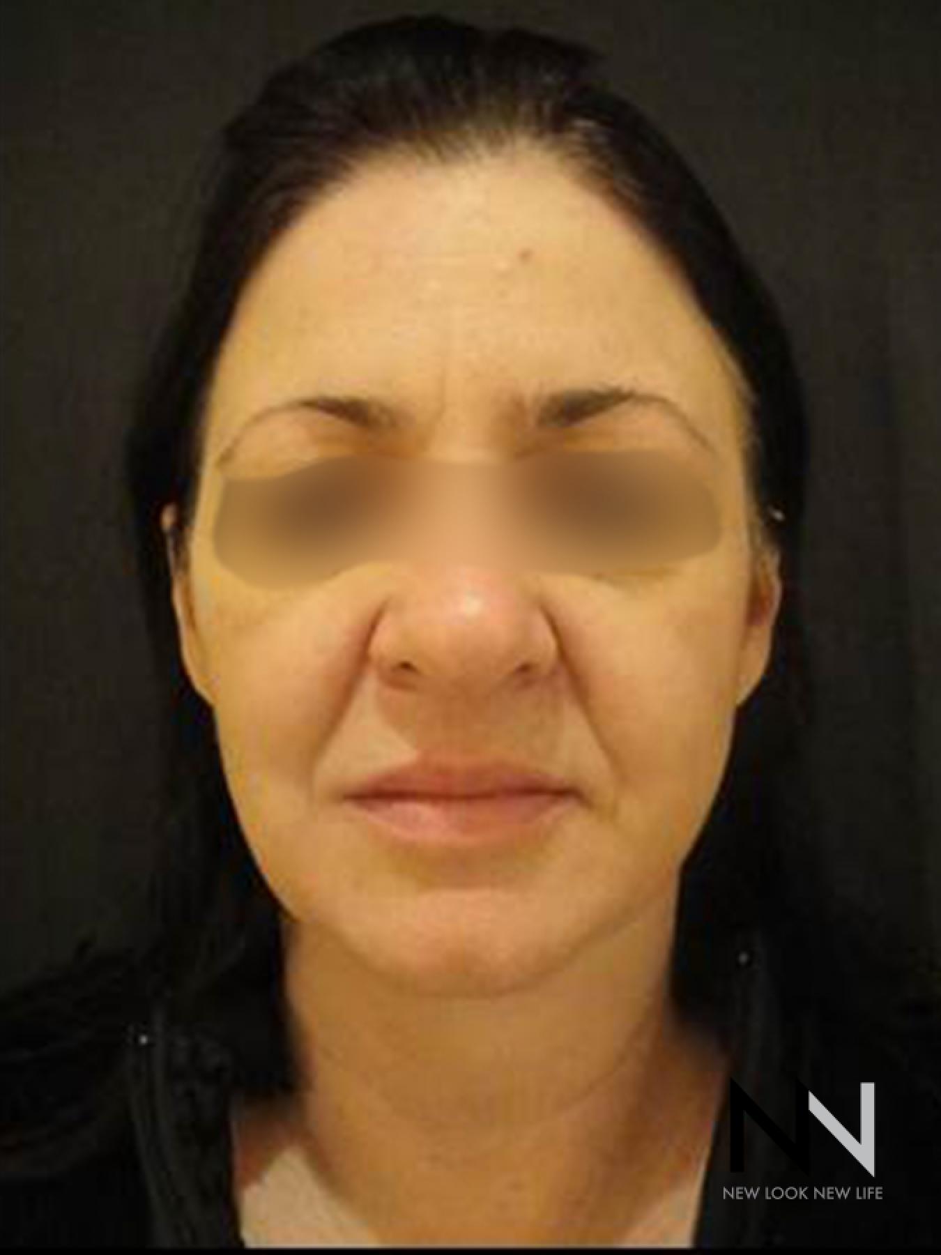 Liquid Facelift: Patient 4 - Before 1