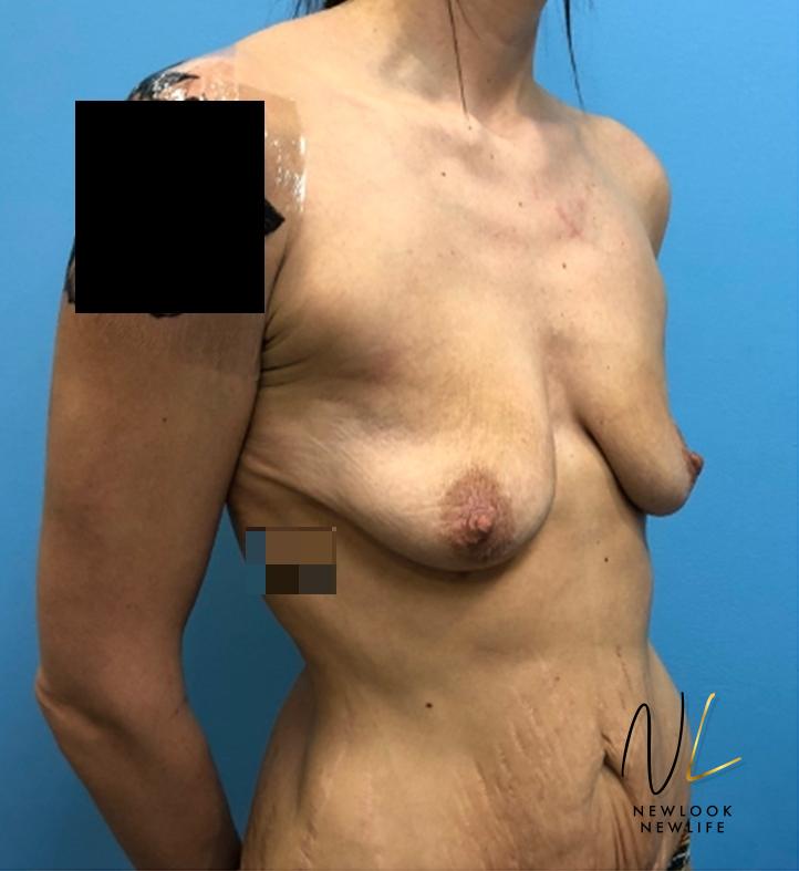 Abdominoplasty: Patient 31 - Before and After 2