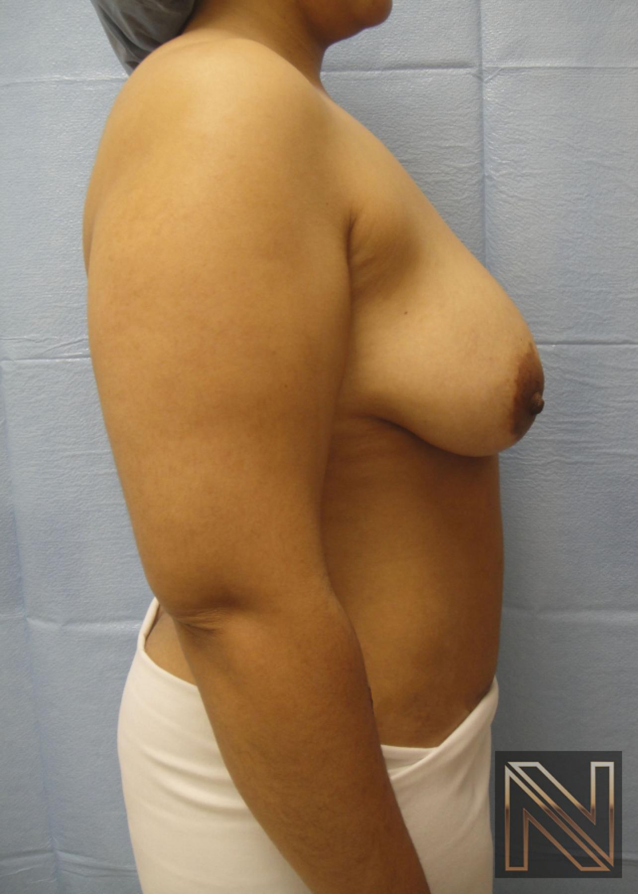 Breast Lift: Patient 6 - Before 4