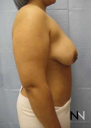 Breast Lift: Patient 6 - Before Image 4