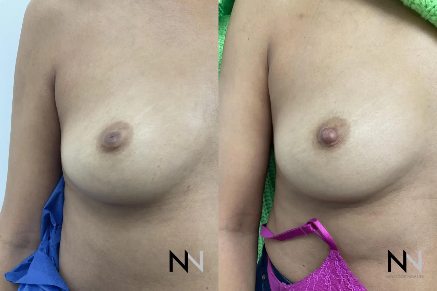 Inverted Nipple Surgery: Patient 4 - Before and After  