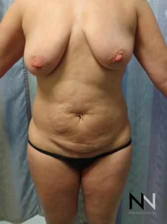 Mini Tummy Tuck: Patient 7 - Before Image 1