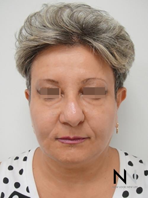 Liquid Facelift: Patient 3 - After  