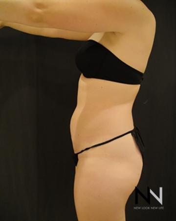 Liposuction: Patient 8 - Before Image 2