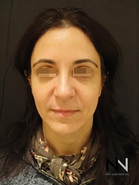 Liquid Facelift: Patient 1 - After 1