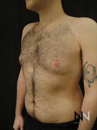 Gynecomastia: Patient 5 - After Image 2