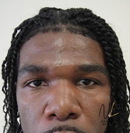 Blepharoplasty: Patient 2 - After Image 1