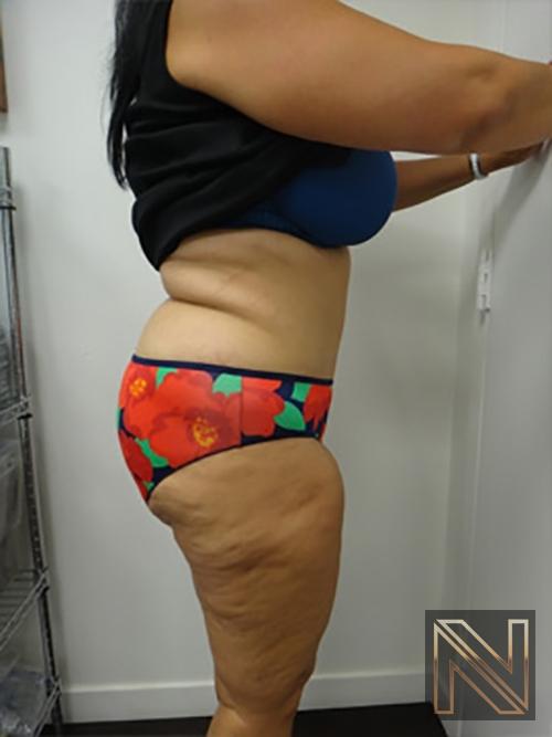 Abdominoplasty: Patient 14 - After 3
