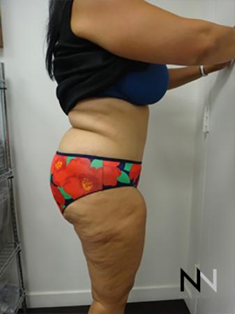 Abdominoplasty: Patient 14 - After Image 3