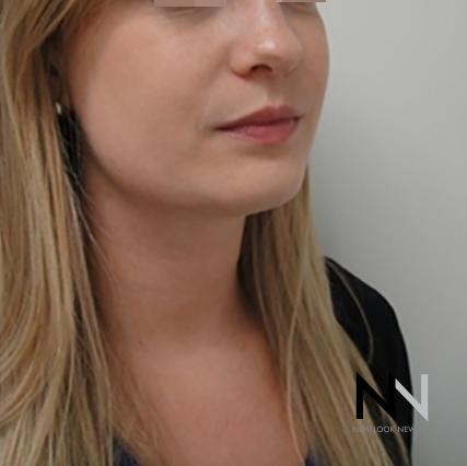 Liposuction: Patient 1 - After Image 3