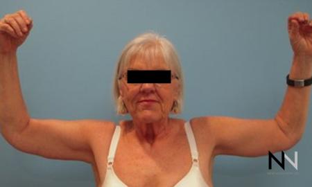Brachioplasty: Patient 9 - After Image 1