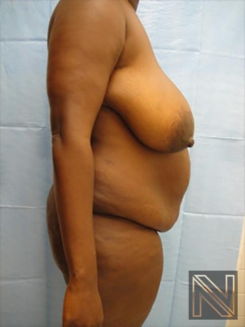 Abdominoplasty: Patient 9 - Before and After 3