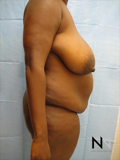 Abdominoplasty: Patient 9 - Before and After 3