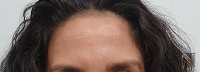 BOTOX® Cosmetic: Patient 3 - After 1
