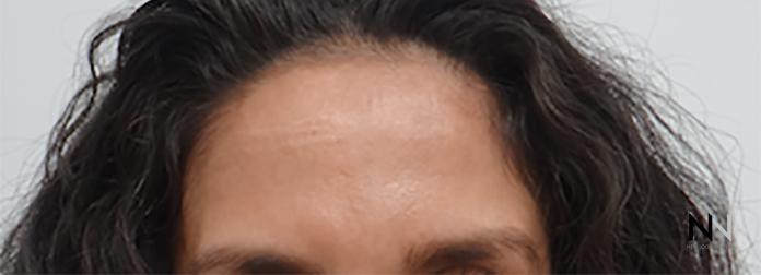 BOTOX® Cosmetic: Patient 3 - After  