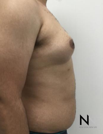 Gynecomastia: Patient 10 - Before Image 3