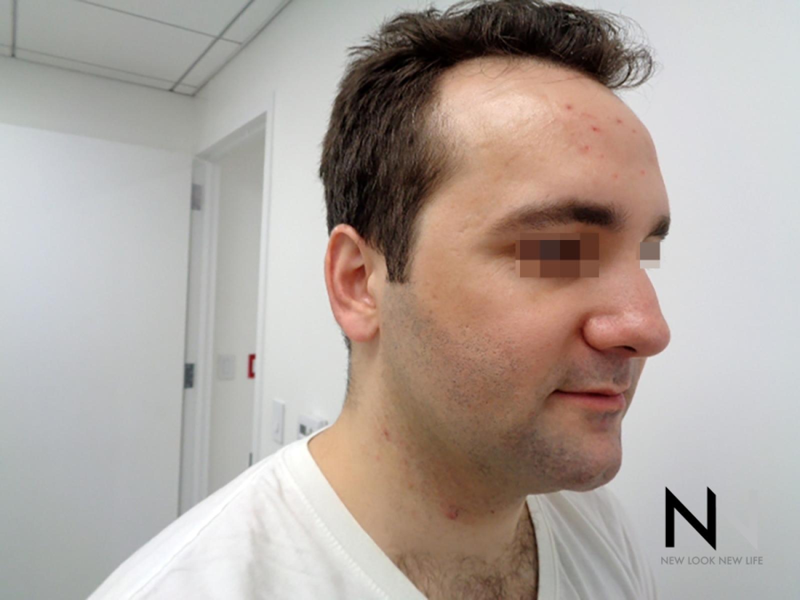 Laser Skin Resurfacing - Face: Patient 3 - Before 3