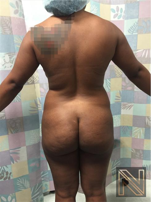Butt Augmentation: Patient 4 - Before and After 4