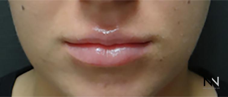 Fillers: Patient 3 - After  