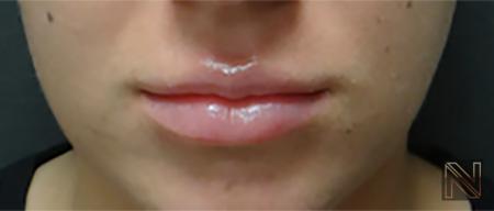 Fillers: Patient 3 - After  