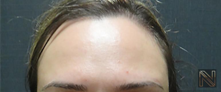 BOTOX® Cosmetic: Patient 1 - After 1