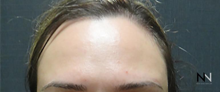 BOTOX® Cosmetic: Patient 1 - After  