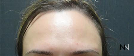 BOTOX® Cosmetic: Patient 1 - After Image 1