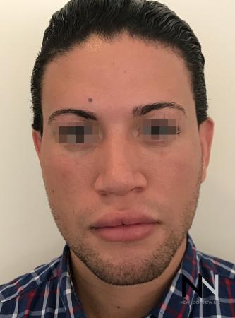Fillers: Patient 13 - After Image 1