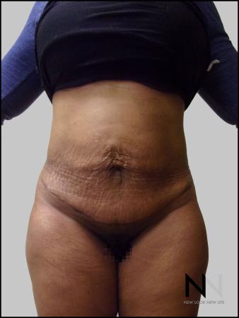 Mini Tummy Tuck: Patient 3 - After Image 1