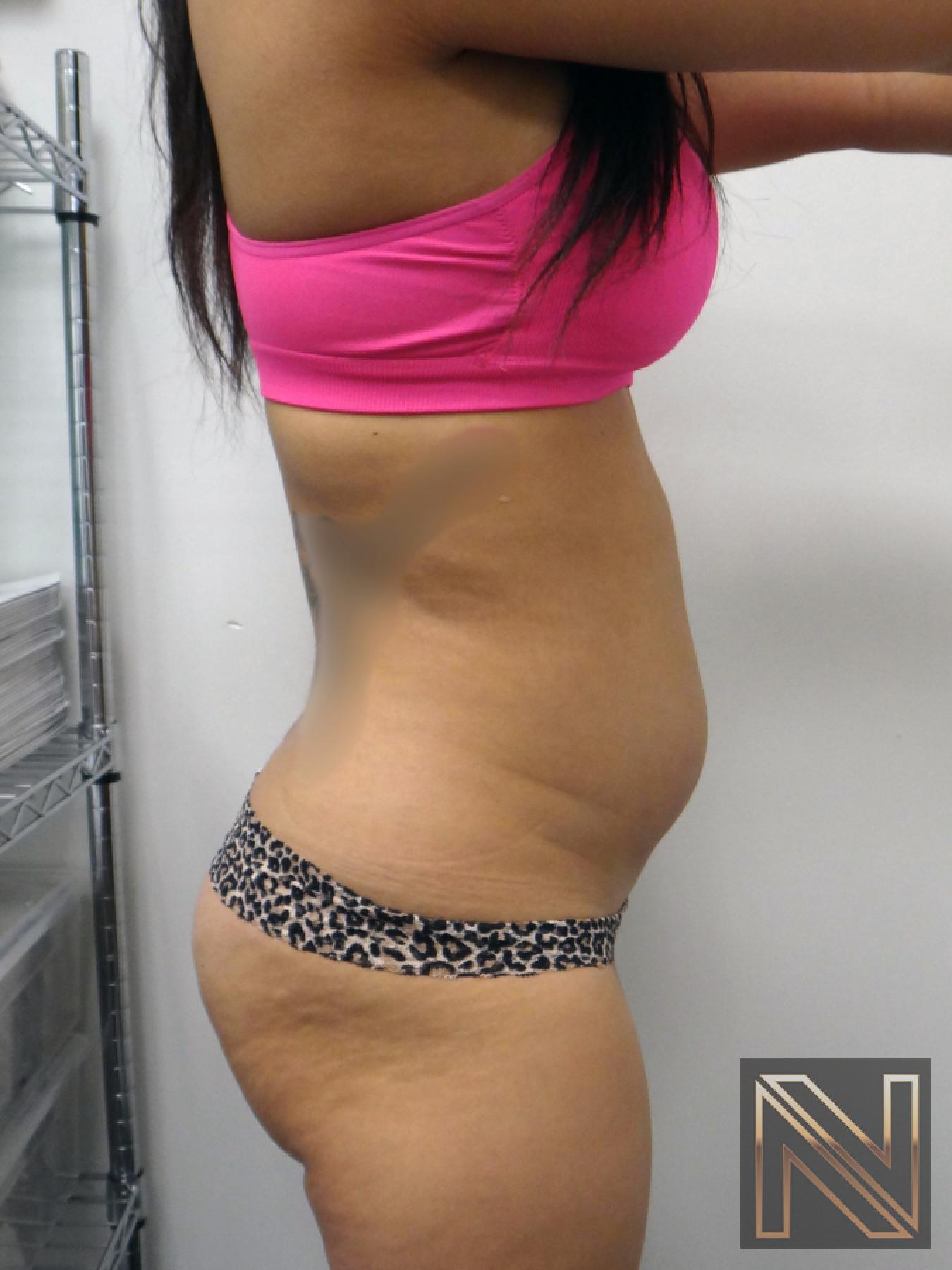 Liposuction: Patient 9 - Before 2
