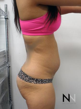 Liposuction: Patient 9 - Before Image 2