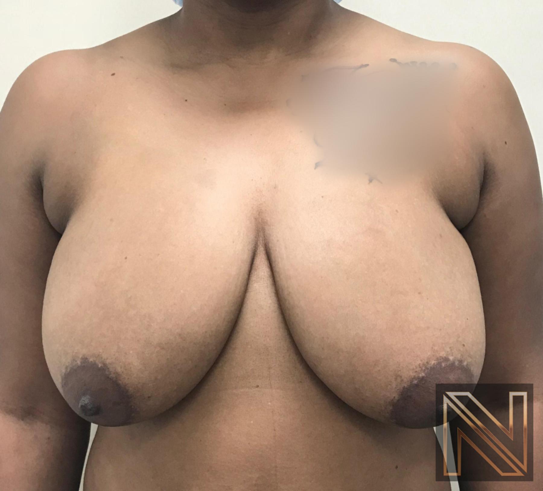 Breast Lift: Patient 14 - Before 1