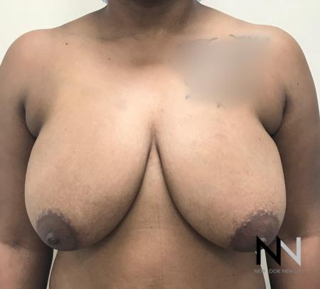 Breast Lift: Patient 14 - Before Image 1