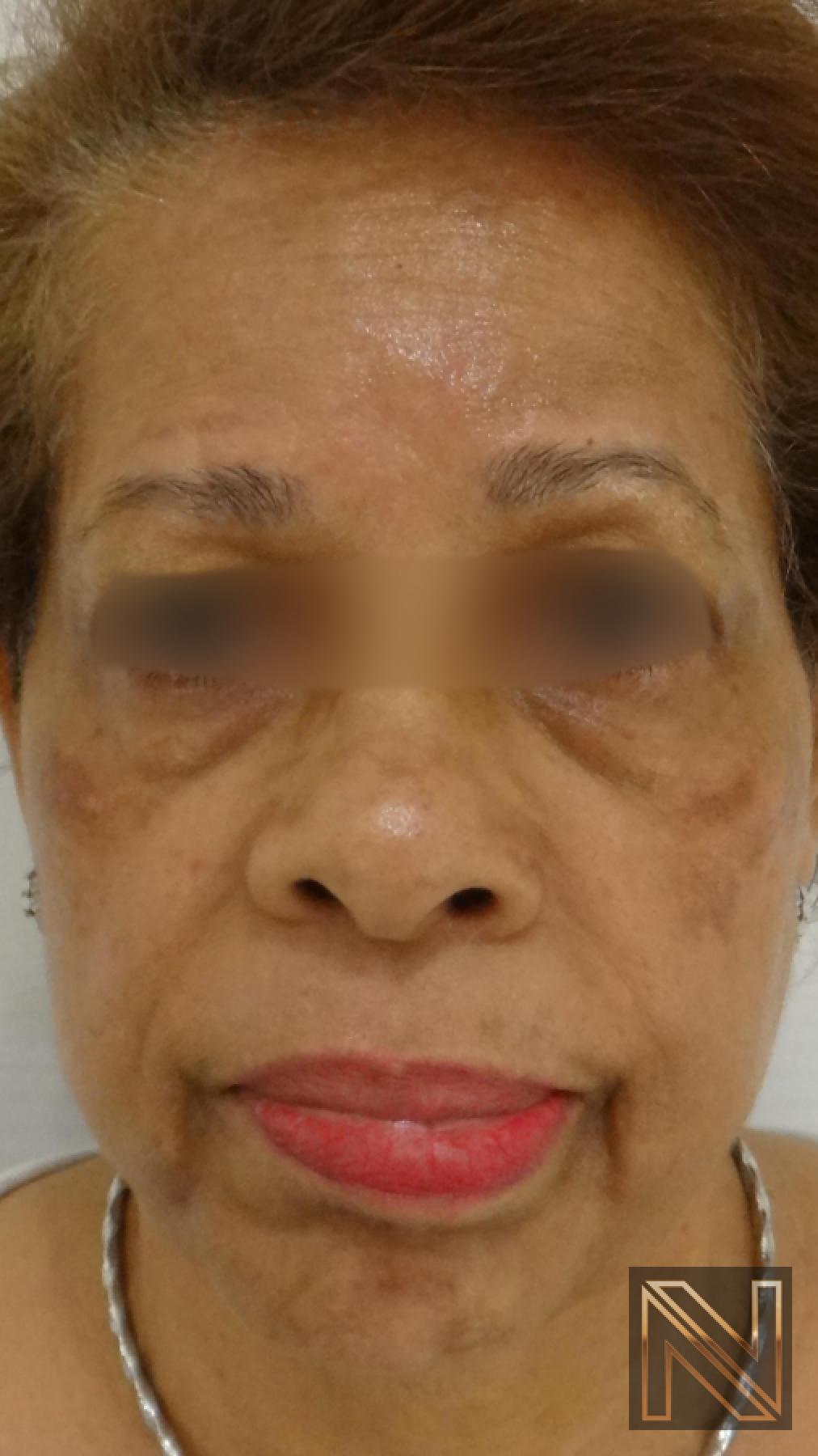 Laser Skin Resurfacing - Face: Patient 2 - Before 1