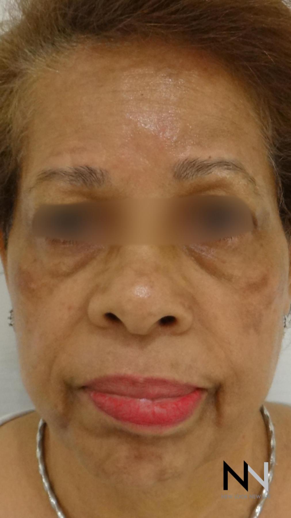 Laser Skin Resurfacing - Face: Patient 2 - Before 1