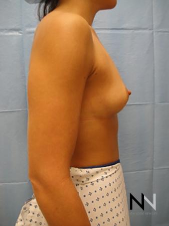 Breast Augmentation: Patient 11 - Before and After Image 5