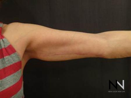 Brachioplasty: Patient 8 - After Image 2