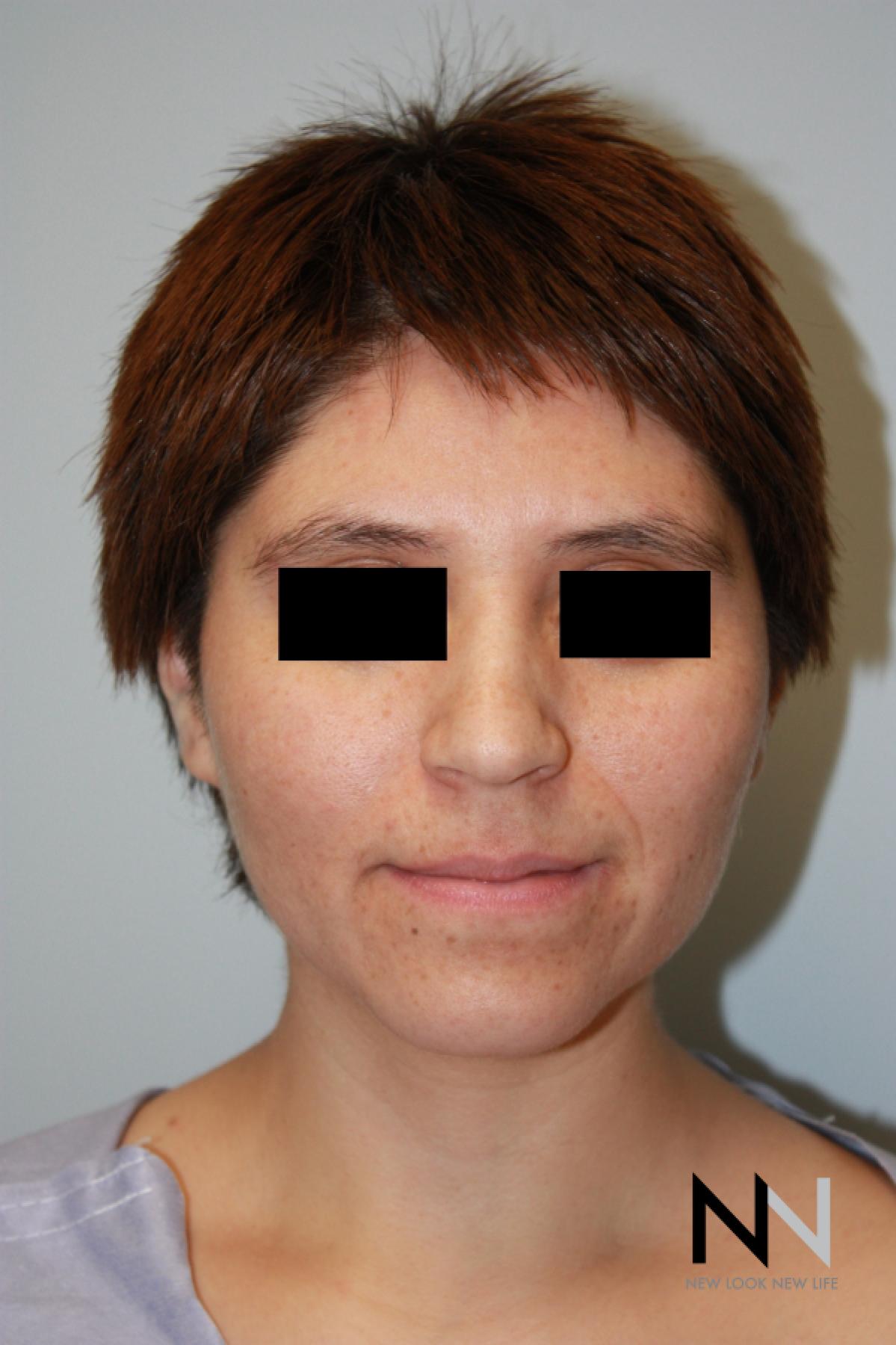 Rhinoplasty: Patient 5 - Before 1