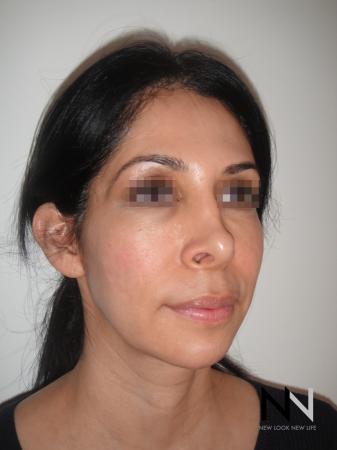 Fractional Resurfacing: Patient 3 - After Image 2