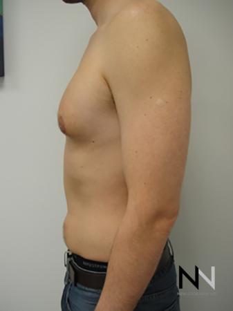 Gynecomastia: Patient 4 - After Image 4