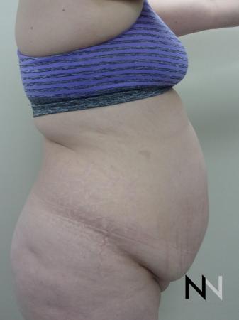 Abdominoplasty: Patient 21 - Before Image 2