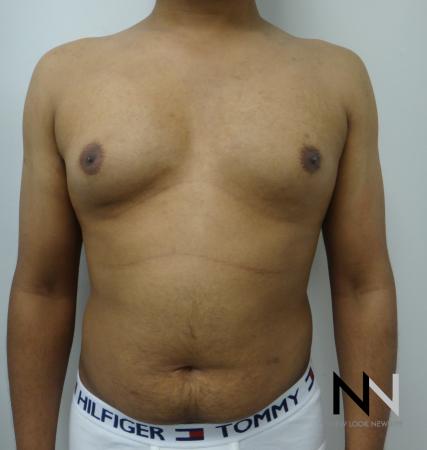 Gynecomastia: Patient 6 - Before Image 1