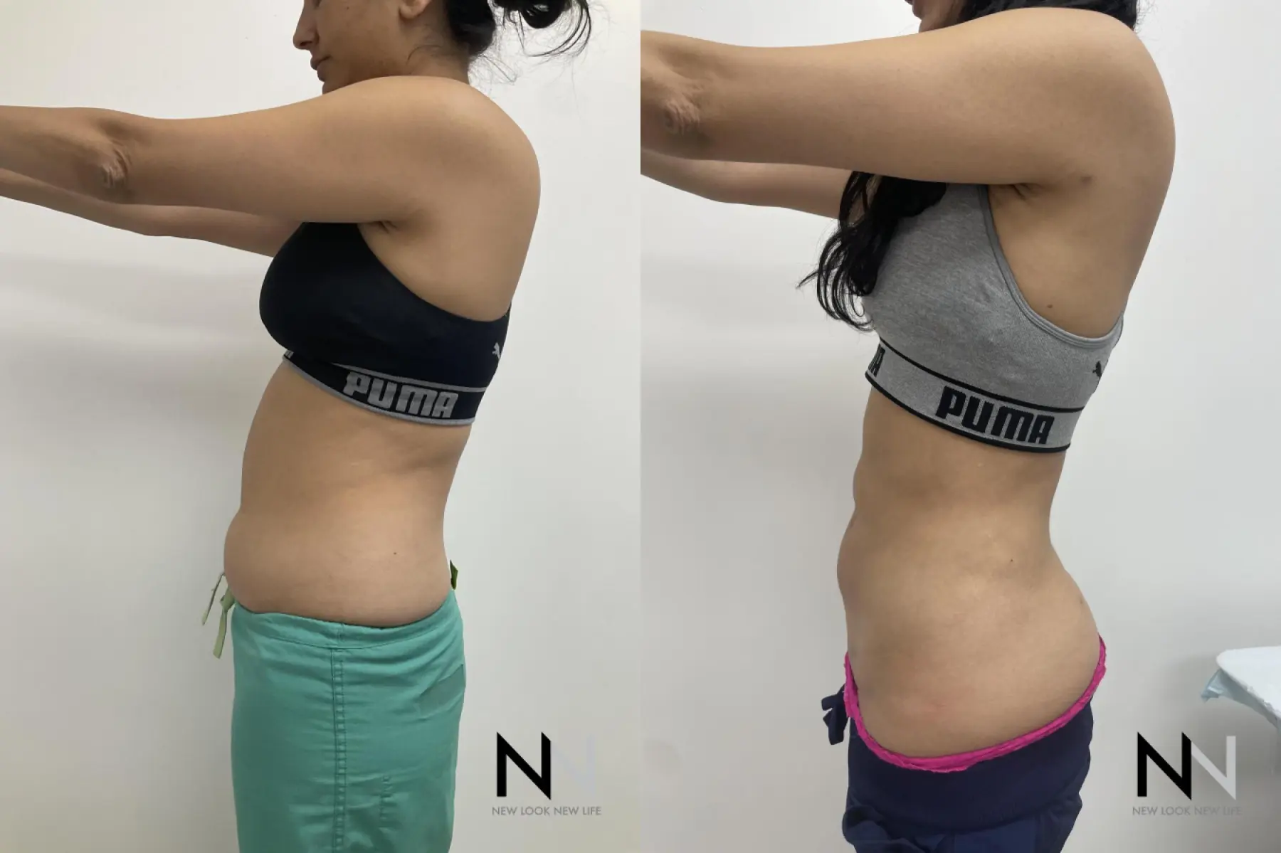 Liposuction: Patient 14 - Before and After 4