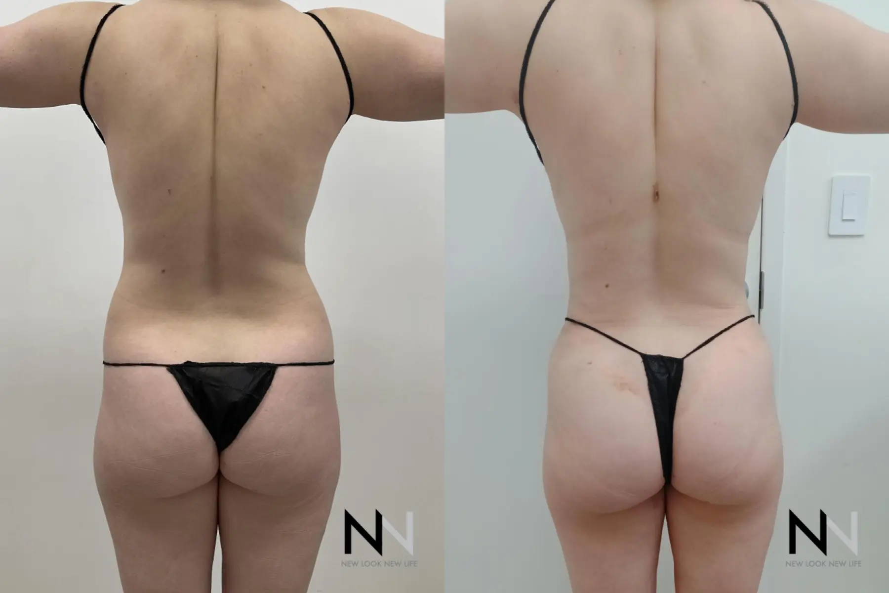 Liposuction: Patient 15 - Before and After 4