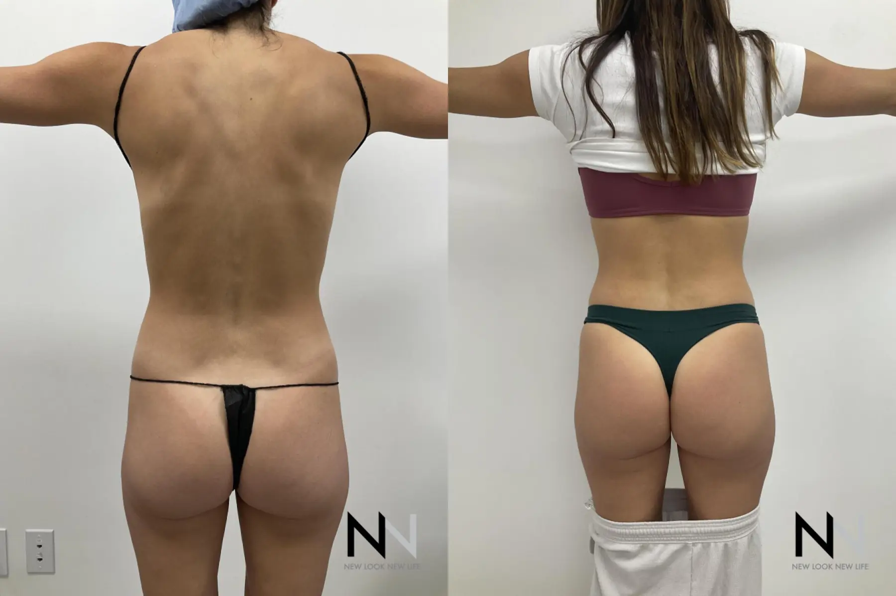 Liposuction: Patient 3 - Before and After 4