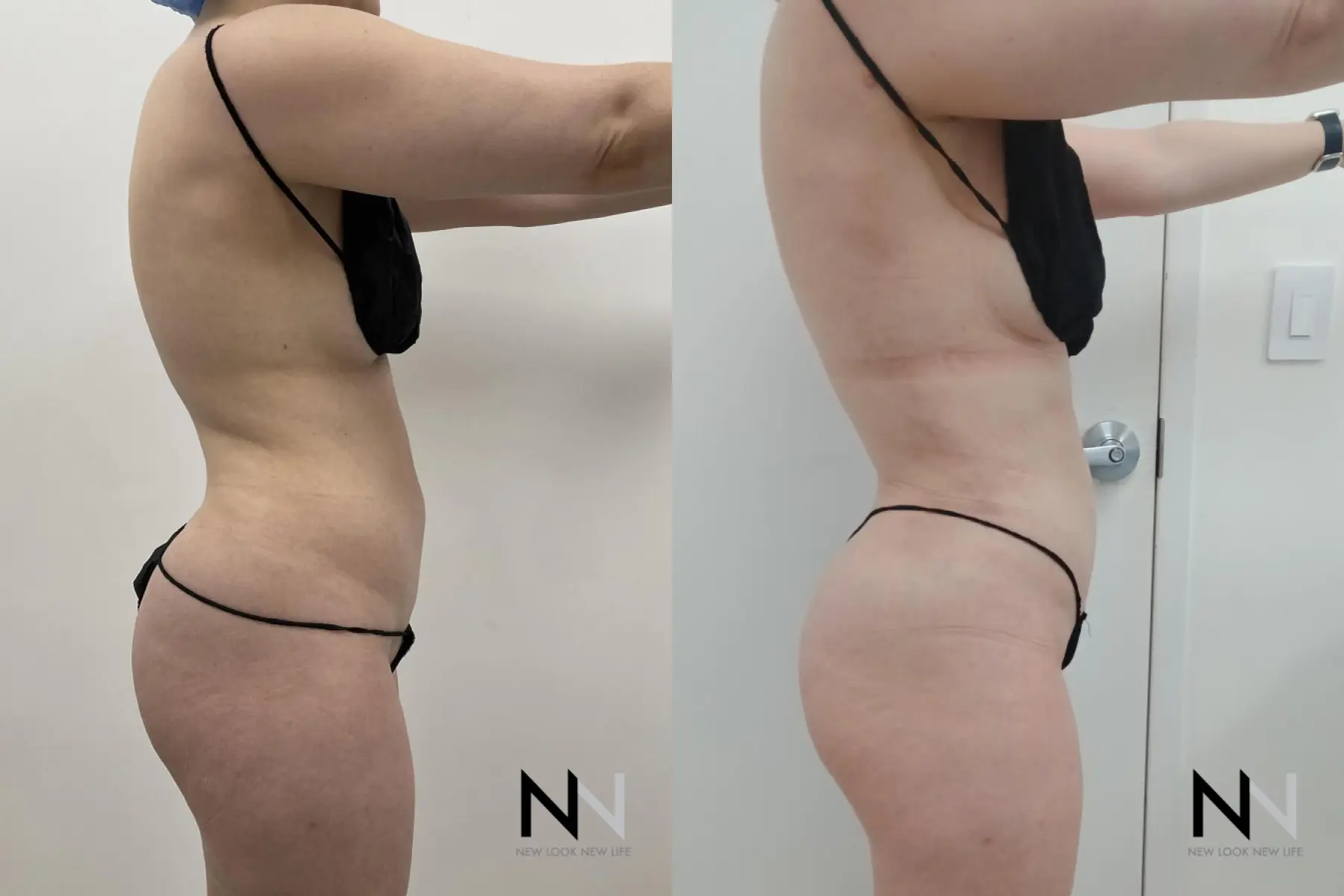 Liposuction: Patient 15 - Before and After 3
