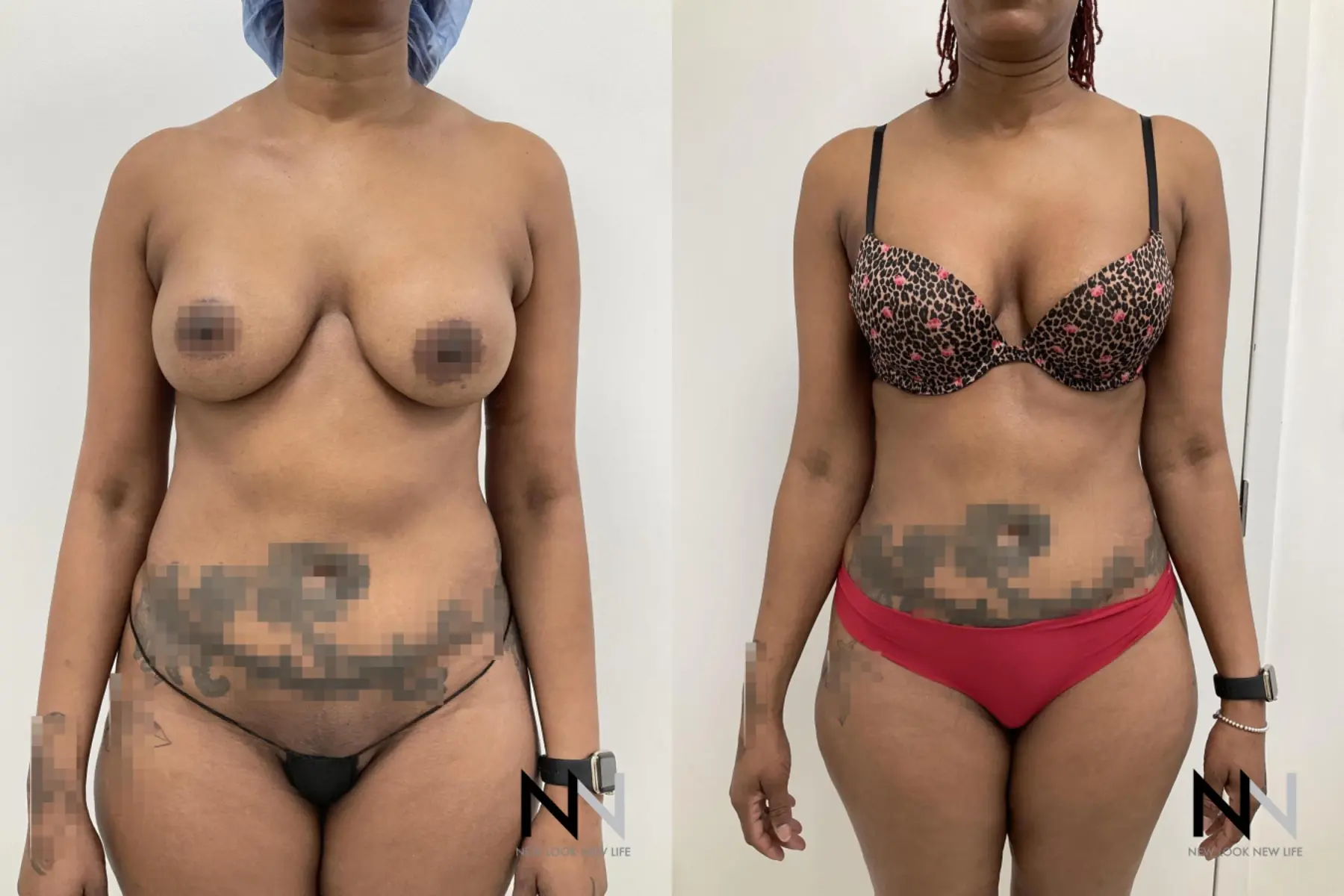 Liposuction: Patient 19 - Before and After  